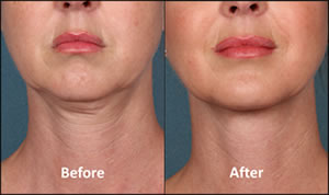 Kybella Patient Before and After Front View