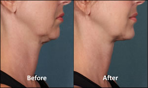 Kybella Patient Before and After Side View